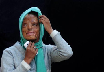 تیزاب حملے کی صورت میں ابتدائی طبی امداد کے طور پر سب سے پہلے کیا اقدامات کرنے چاہئیں؟